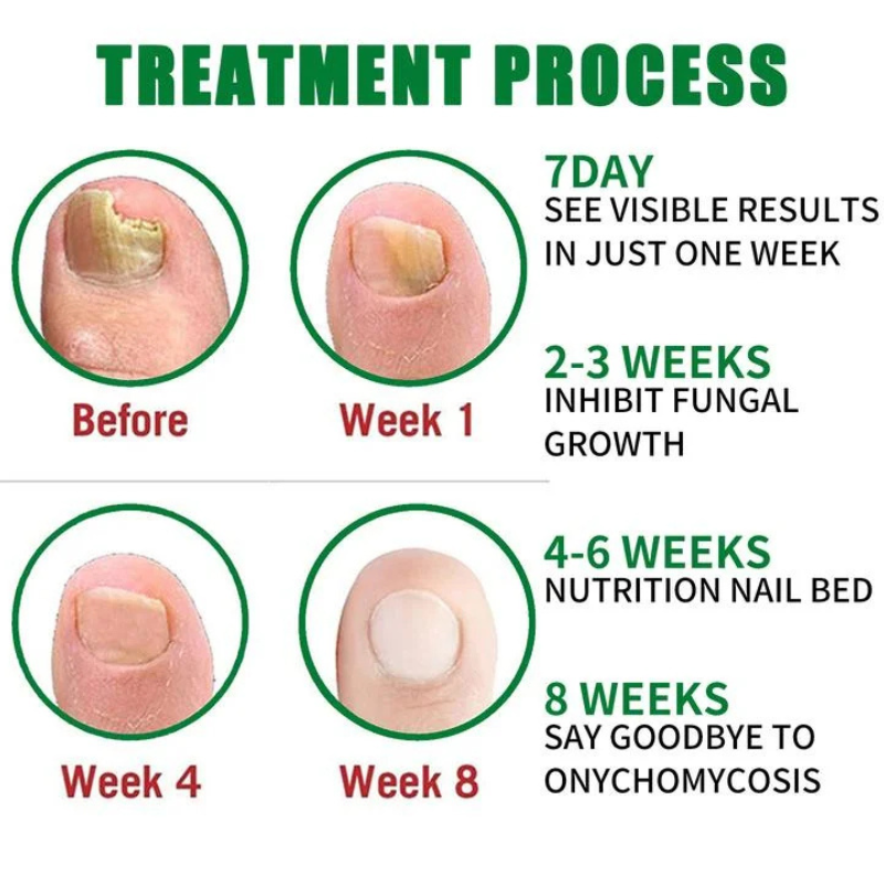 Nail treatment – Natural antifungal care