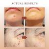 Wipe-off Mole and Stain Remover