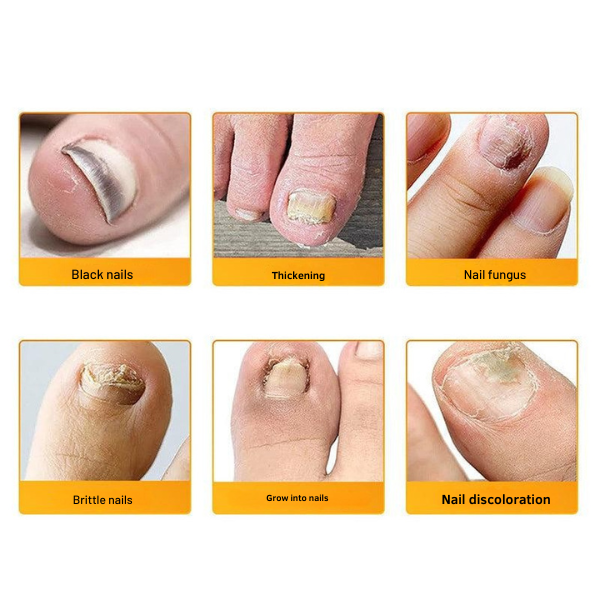 1+1 FREE | Nailox™ – Fast & Discreet Nail Fungus Treatment