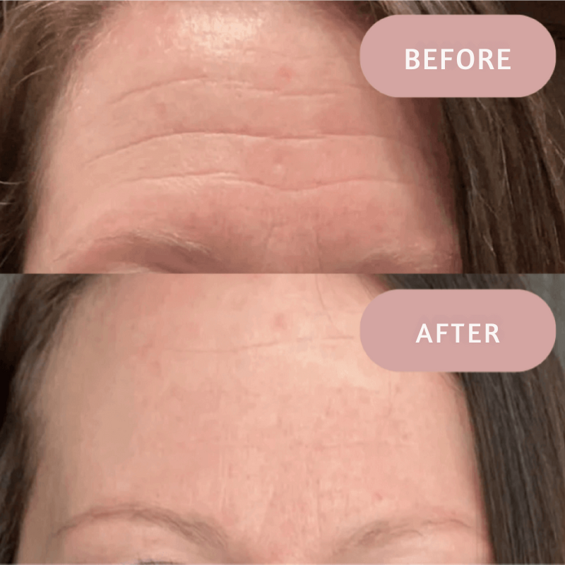 Ephylift - Silicone anti-wrinkle patches that regenerate and plump your skin