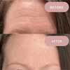 Ephylift - Silicone anti-wrinkle patches that regenerate and plump your skin
