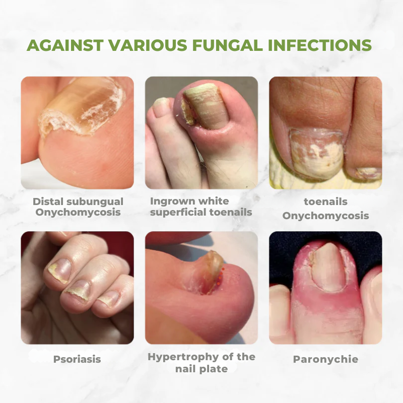 NectarNail Bee Poison Nail Repair Oil | Eliminates Fungus, Restores and Strengthens Nails
