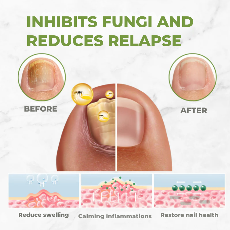 NectarNail Bee Poison Nail Repair Oil | Eliminates Fungus, Restores and Strengthens Nails