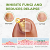 NectarNail Bee Poison Nail Repair Oil | Eliminates Fungus, Restores and Strengthens Nails
