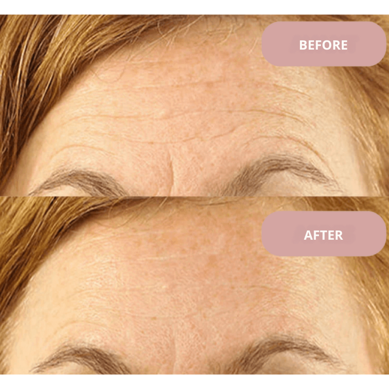 Ephylift - Silicone anti-wrinkle patches that regenerate and plump your skin