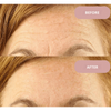 Ephylift - Silicone anti-wrinkle patches that regenerate and plump your skin