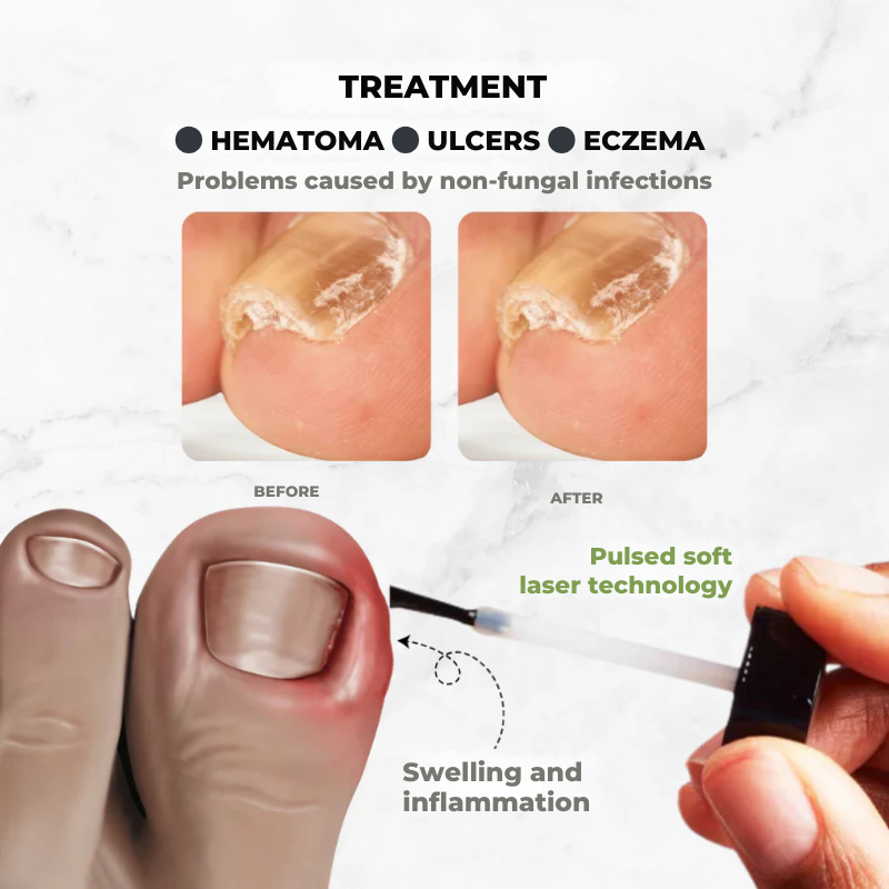 NectarNail Bee Poison Nail Repair Oil | Eliminates Fungus, Restores and Strengthens Nails