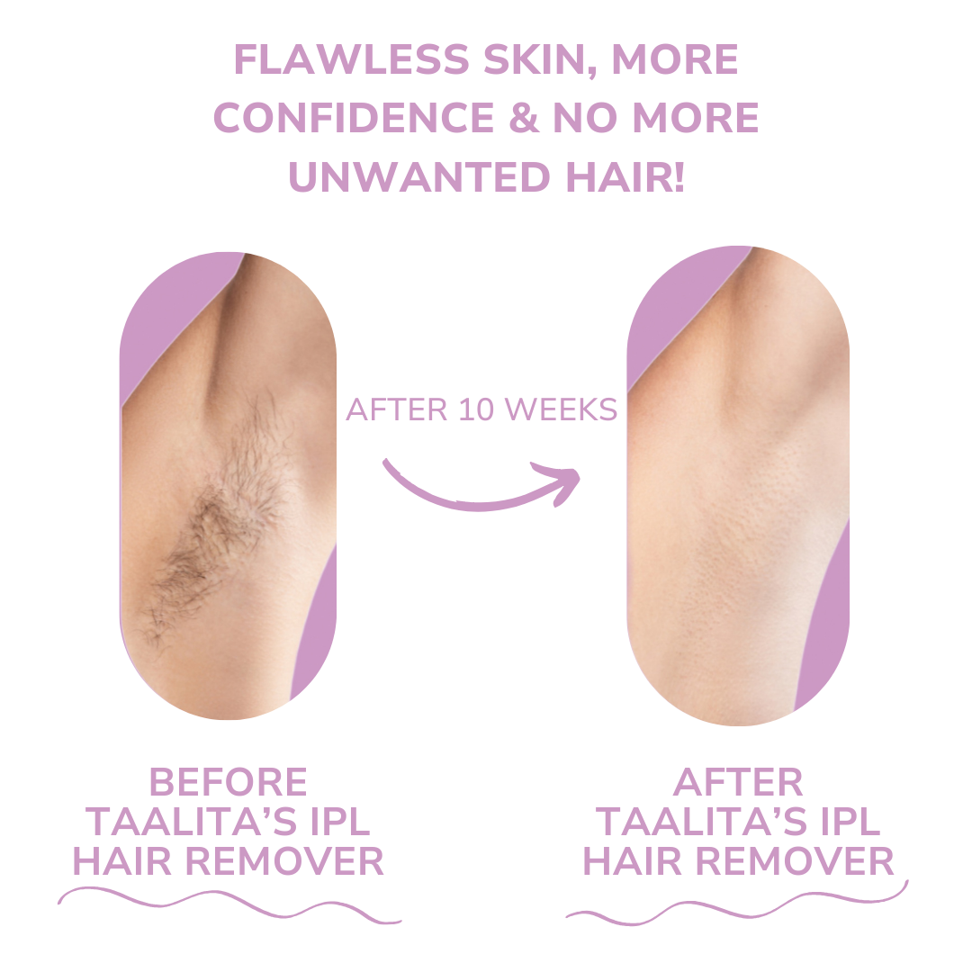 Glow Soft™ Painless Hair Removal
